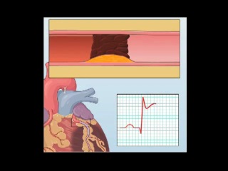 percutaneous balloon angioplasty and stenting animation by nejm