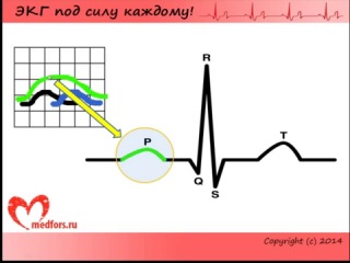 lesson 2. ecg video course for everyone.
