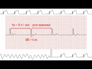 ectopic rhythms