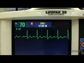 ecg monitoring